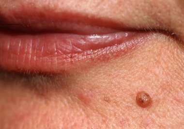 Çenedeki benler. Çenesindeki doğum lekesi.