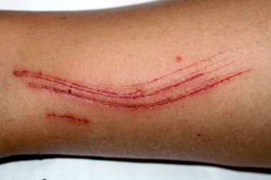 Large cut on the leg. Skin abrasion. clipart