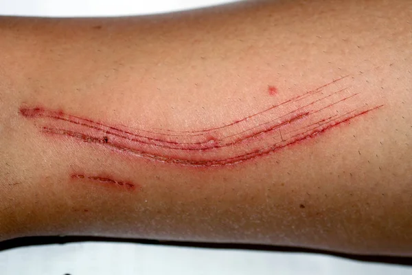Large cut on the leg. Skin abrasion. — Stock Photo, Image