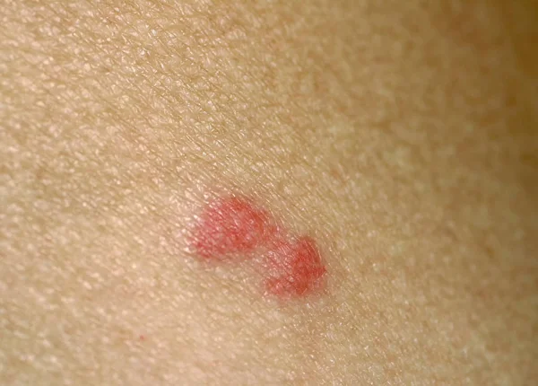 蚊子咬在皮肤上。滴答声叮咬. — 图库照片