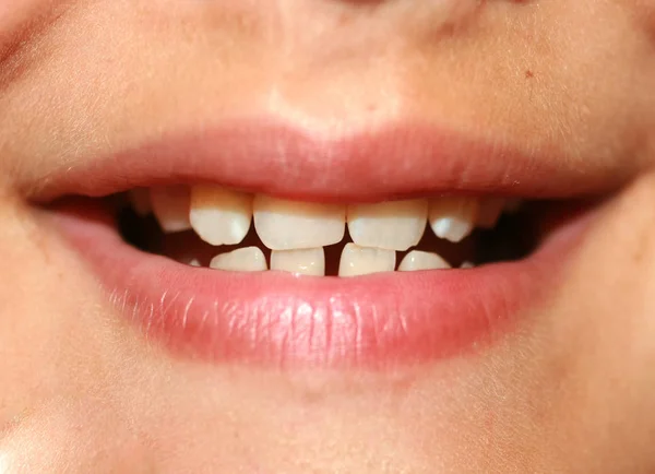 Incorrect bite in a child. Malocclusion in children. Crooked teeth. — Stock Photo, Image