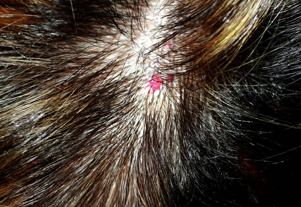 Hämangiom am Kopf. roter Maulwurf auf der Kopfhaut. Maulwurf im Haar. rotes Muttermal. — Stockfoto