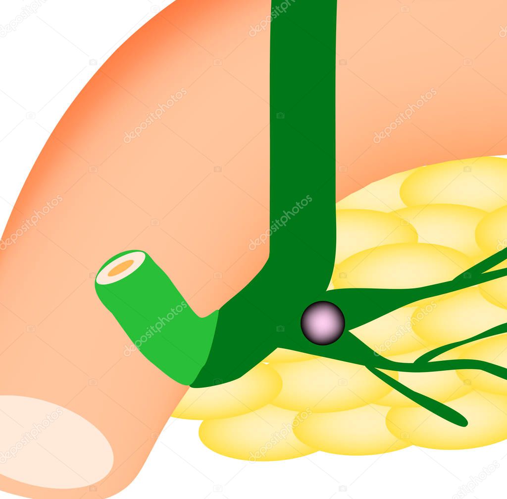 Stone pancreatic bile duct. The most dangerous rock. The gall bladder, duodenum, bile ducts. Vector illustration on isolated background