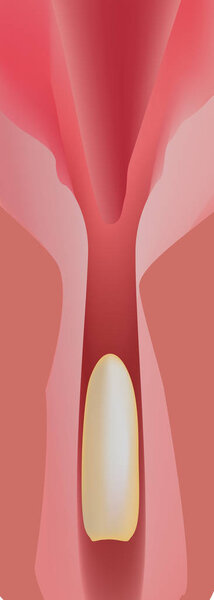 Противозачаточные суппозитории. Инфографика. Векторная иллюстрация на изолированном фоне
