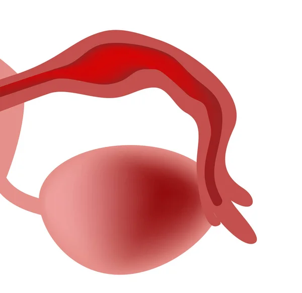 Salpingitis. Inflammation of the fallopian tube. Oophoritis. the ovary. pelvic organs. Infographics. Vector illustration on isolated background — Stock Vector