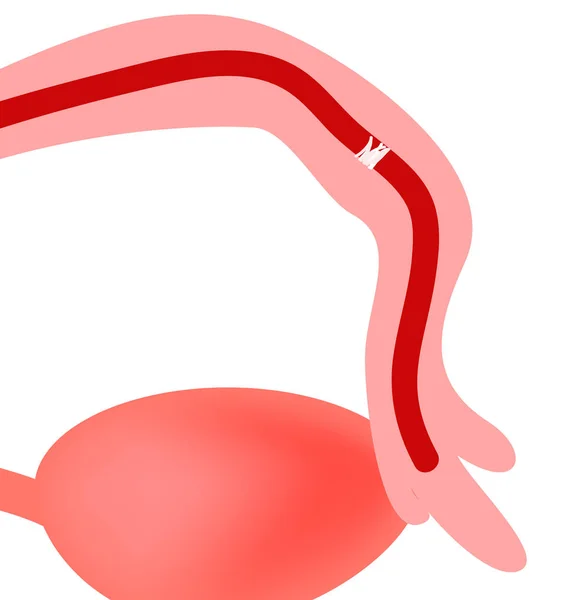 卵管の閉塞。骨盤内臓器の構造。インフォ グラフィック。孤立した背景のベクトル図 — ストックベクタ