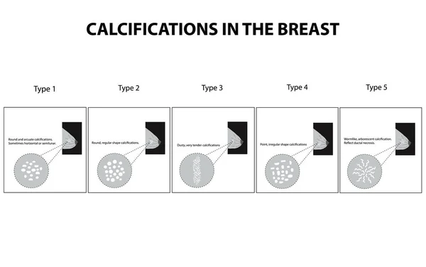 Clasificación de calcificaciones en la glándula mamaria. Mamografía. La glándula mamaria. Infografías. Ilustración vectorial sobre fondo aislado — Vector de stock