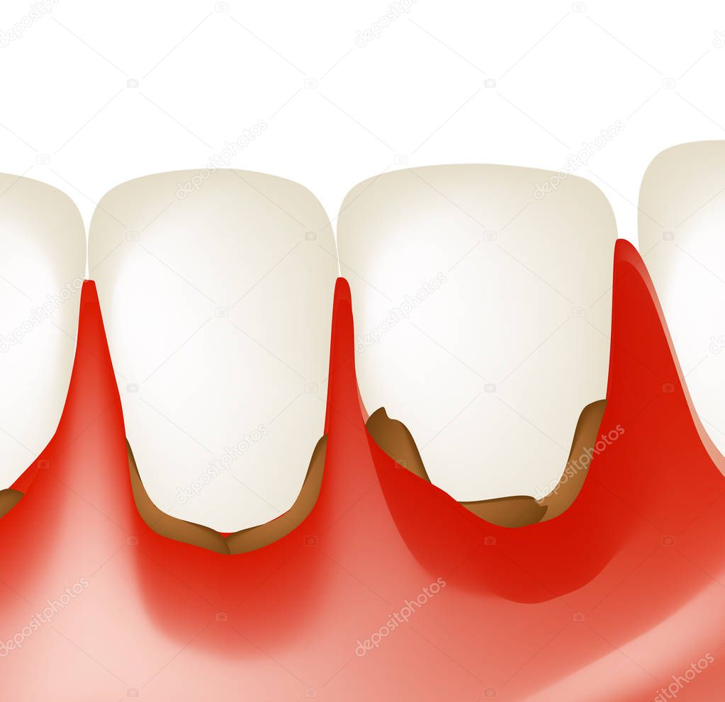 Gingivitis. Inflammation of the gums. Dental calculus. Infographics. Vector illustration on isolated background