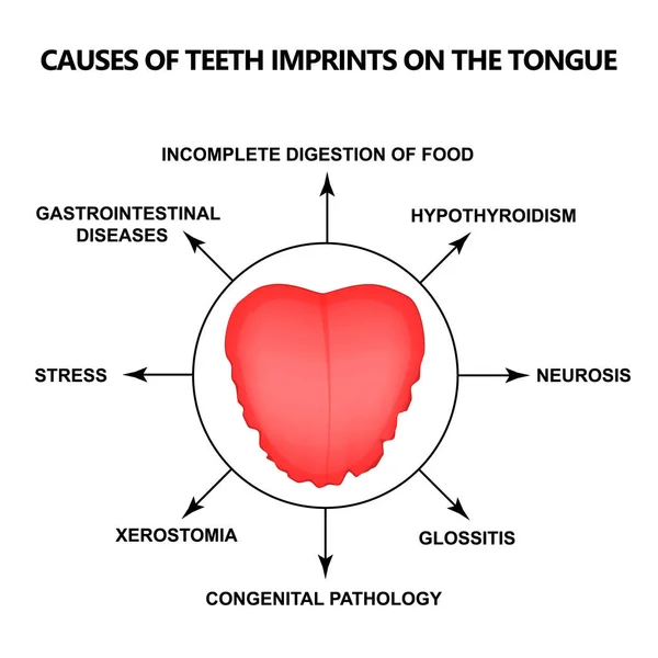舌に歯の痕跡が刻み出された原因。人間の舌による疾患の定義。舌による診断。孤立した背景上の舌ベクトルイラスト. — ストックベクタ