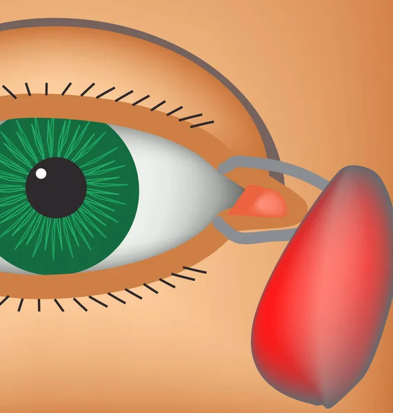 Dakryocyst. Zapalenie worka łzowych oka. Struktura oka. Infografiki. Ilustracja wektorowa — Wektor stockowy