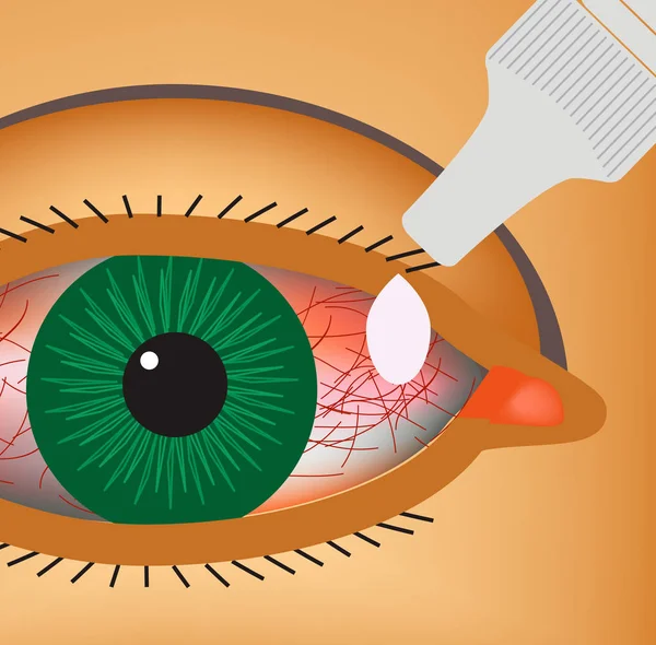 Konjungtivitis. Kemerahan dan peradangan mata. Kapal. Tetes mata. Infografis. Ilustrasi vektor . - Stok Vektor