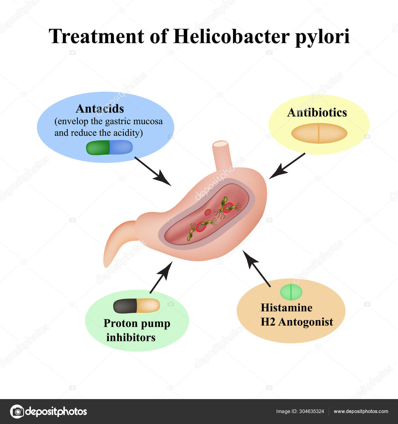 Treatment of Helicobacter pylori. Medications. Antacids, proton pump