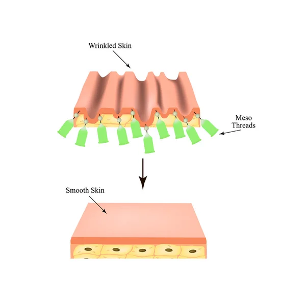 Sollevamento fili mesoterapia. fili per lifting facciale. La struttura della pelle. Le rughe. Infografica. Illustrazione vettoriale su sfondo isolato . — Vettoriale Stock