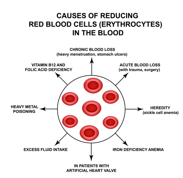 Cause di riduzione delle cellule del sangue rosso. Cellule eritrociti. Emoglobina. La struttura dei globuli rossi. Infografica. Illustrazione vettoriale su sfondo isolato . — Vettoriale Stock