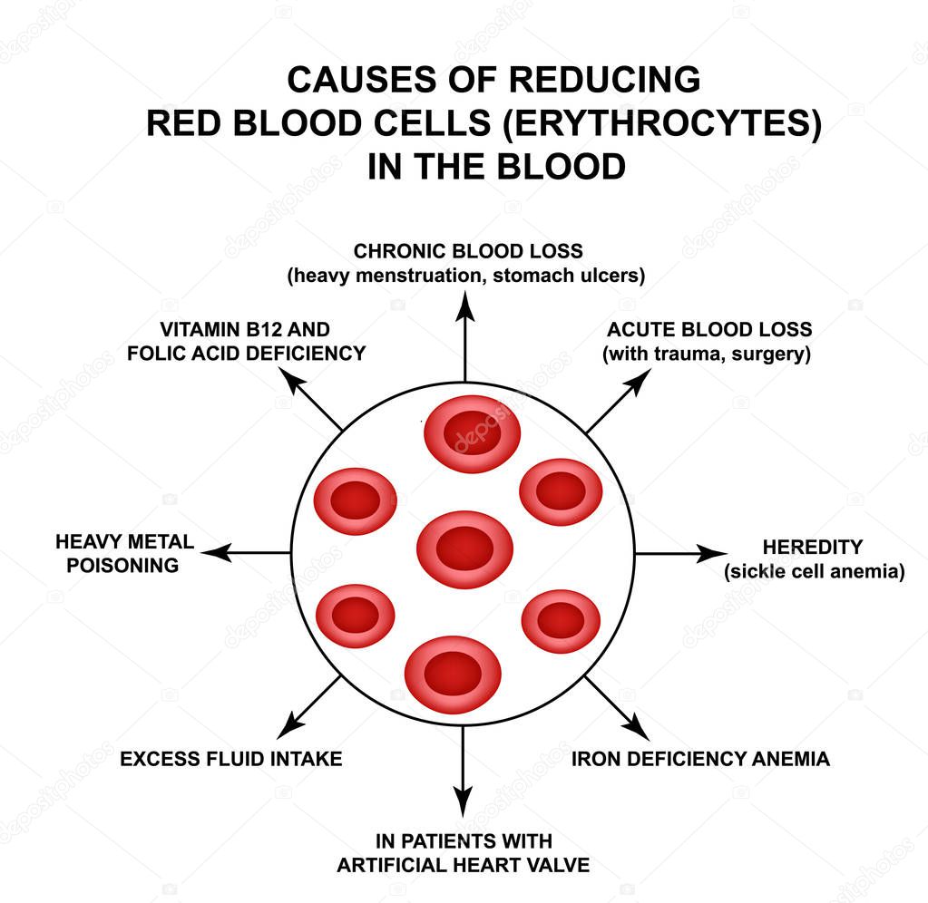 Causes of Reducing Red Blood Cells. Cells erythrocytes. Hemoglobin. The structure of red blood cells. Infographics. Vector illustration on isolated background.