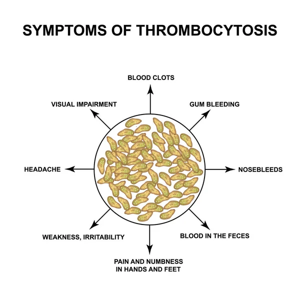 Síntomas de trombocitosis. Aumento de plaquetas en la sangre. Infografías. Ilustración vectorial sobre fondo aislado . — Vector de stock