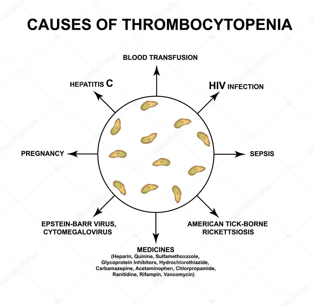 Causes of thrombocytopenia. Reducing platelets in the blood. Infographics. Vector illustration on isolated background.