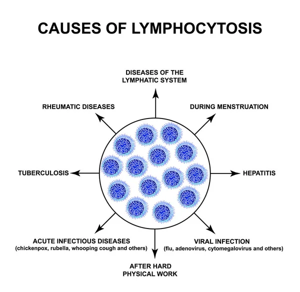 Cause di linfocitosi. L'aumento dei linfociti nel sangue. Assassini di cellule. Cellule di aiuto all'immunità. Infografica. Illustrazione vettoriale su sfondo isolato . — Vettoriale Stock