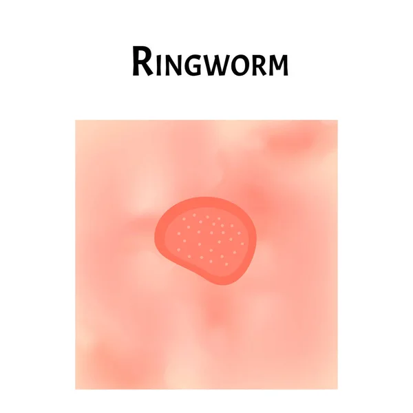Ringworm on the skin. Vector illustration on isolated background — Stock Vector