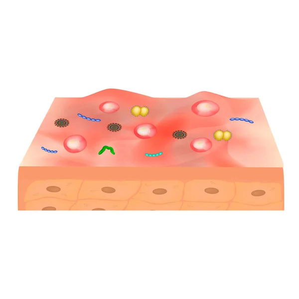 Piel inflamada con bacterias. Enfermedades infecciosas de la piel. Ilustración vectorial sobre fondo aislado — Vector de stock