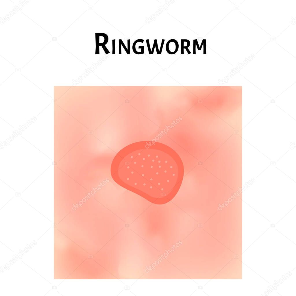 Ringworm on the skin. Vector illustration on isolated background