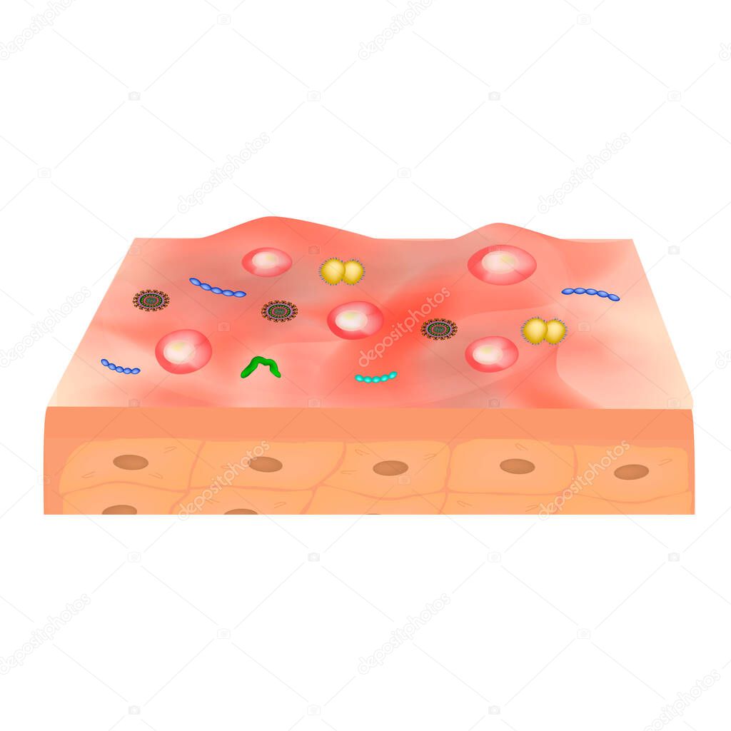 Inflamed skin with bacteria. Infectious diseases of the skin. Vector illustration on isolated background