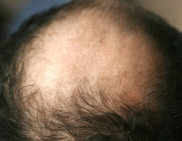 A bald spot on a mans head. Alopecia. Hair loss