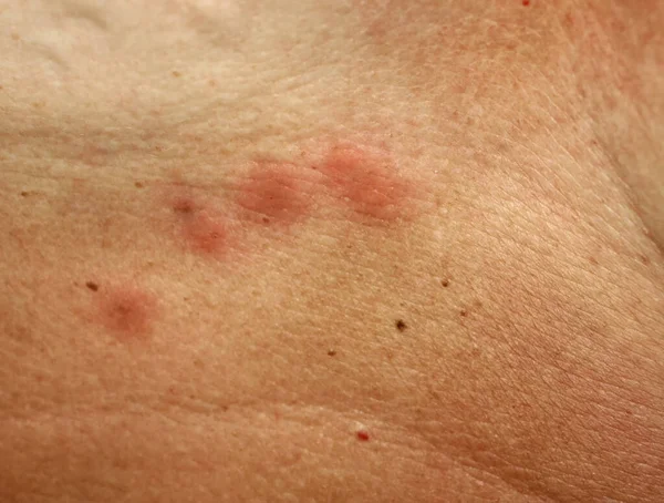 Укуси комарів на шкірі під грудьми — стокове фото