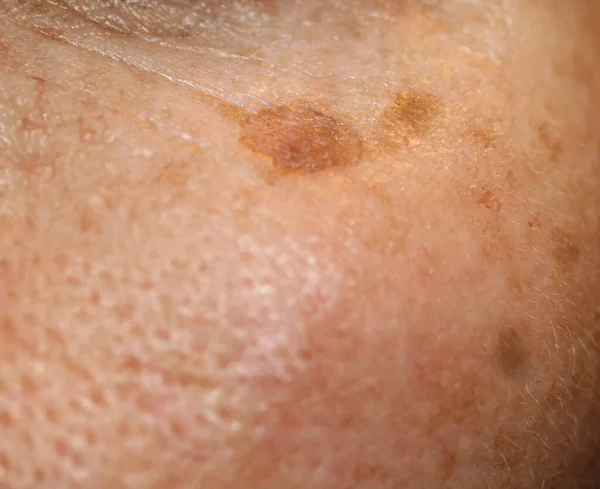 Mancha castanha na pele do rosto. Pigmentação na pele — Fotografia de Stock