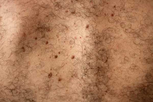 Braune Flecken auf der Haut. Pigmentflecken und Muttermale. Maulwurf und Hauthaar. — Stockfoto