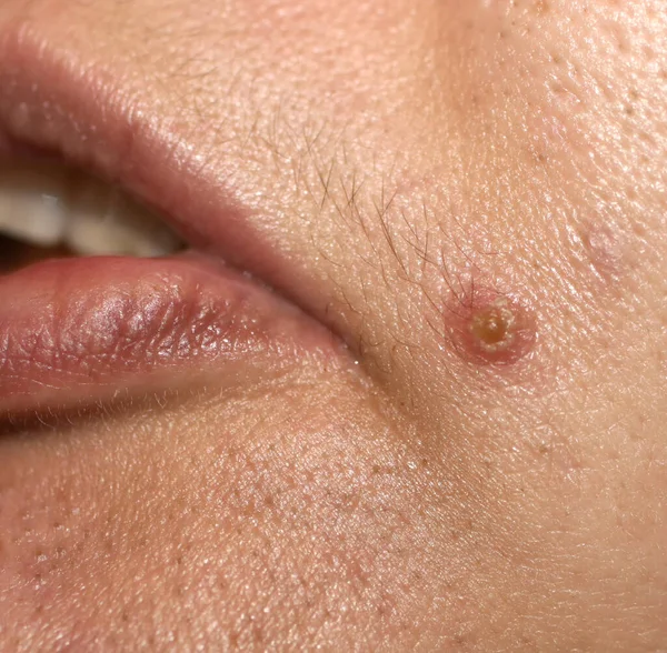 Zánět kůže. Akné na obličeji. Zánětlivé pupínky na kůži — Stock fotografie