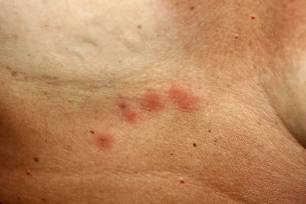 Укуси комарів на шкірі під грудьми — стокове фото