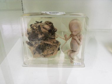 Siriraj Hastanesi, Bangkok, Tayland, 30 Ekim 2015: Bangkok, Tayland 'daki Adli Tıp Müzesi' nde formaldehit korumalı plasenta ile fetüs