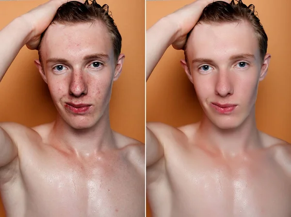 health, people, youth and beauty concept - Before and after cosmetic operation. Young man portrait. Before and after cosmetic or plastic procedure, anti-age therapy, removal of acne, retouching