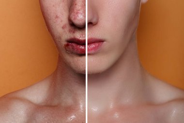 Önce ve sonra kozmetik işlemi. Genç adam portre studio arka plan. Önce ve sonra kozmetik veya plastik yordam, Anti-yaş tedavisi, akne, kaldırılması rötuş. Stüdyo vurdu