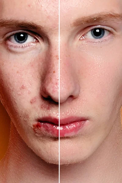 Vóór Cosmetische Operatie Jongeman Portret Studio Achtergrond Voor Cosmetische Plastic — Stockfoto