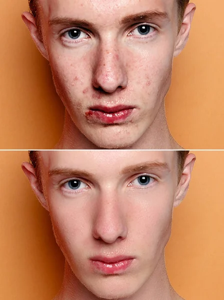 Before and after cosmetic operation. Young man portrait, studio background. Before and after cosmetic or plastic procedure, anti-age therapy, removal of acne, retouching. studio shot