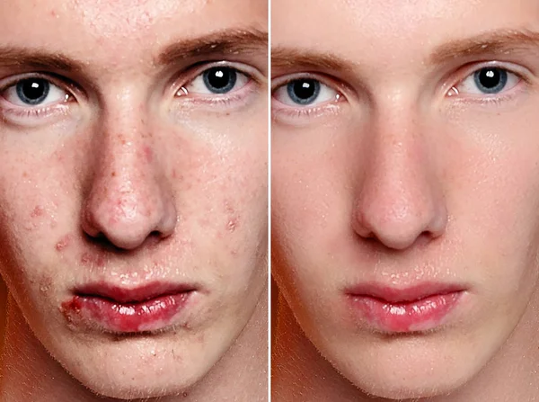 Before and after cosmetic operation. Young man portrait, studio background. Before and after cosmetic or plastic procedure, anti-age therapy, removal of acne, retouching. studio shot