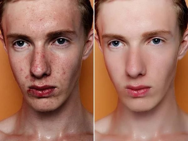 Antes Después Operación Cosmética Retrato Hombre Joven Fondo Del Estudio — Foto de Stock