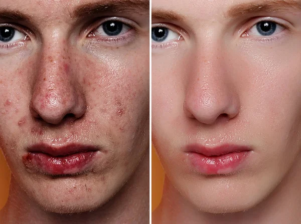 Před Kosmetické Operaci Portrét Mladého Muže Studio Pozadí Před Kosmetické — Stock fotografie