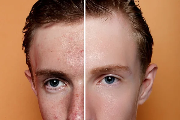 Sebelum Dan Sesudah Operasi Kosmetik Pria Muda Potret Latar Belakang — Stok Foto