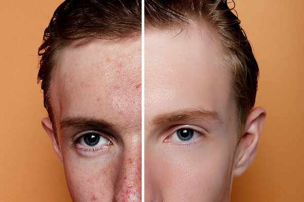 Before and after cosmetic operation. Young man portrait, studio background. Before and after cosmetic or plastic procedure, anti-age therapy, removal of acne, retouching. studio shot