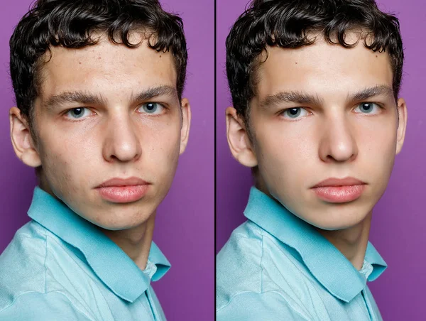 После Косметической Операции Портрет Молодого Человека После Косметической Пластической Процедуры — стоковое фото