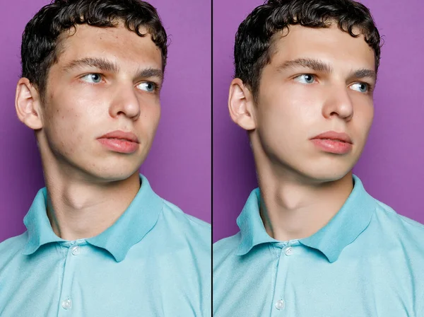 Před Kosmetické Operaci Portrét Mladého Muže Před Kosmetické Nebo Plastické — Stock fotografie