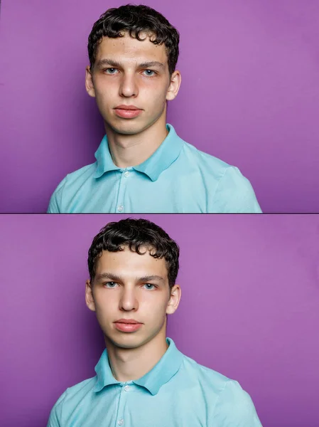 化粧品の前と後 若い男の肖像画 化粧品やプラスチックの手順の前後に アンチエイジング療法 にきびの除去 レタッチ スタジオショット — ストック写真