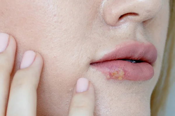 Mulher Com Herpes Vírus Lábios Herpes Nos Lábios Jovem — Fotografia de Stock