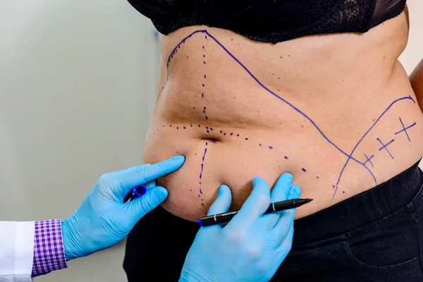 The doctor drawing line on the patients skin — Stock Photo, Image