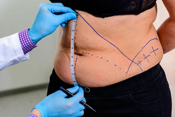 A linha de desenho médico na pele dos pacientes — Fotografia de Stock