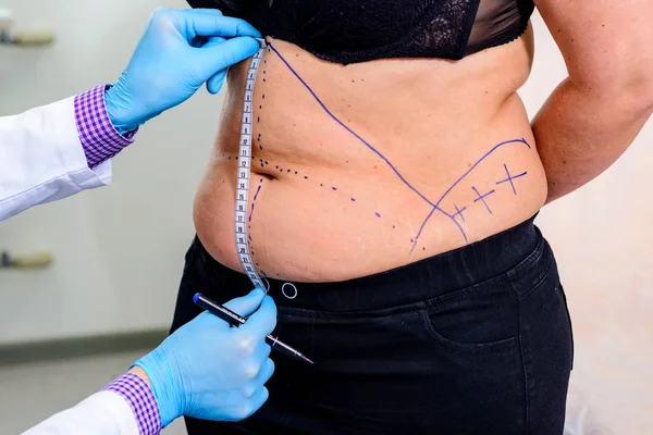 The doctor drawing line on the patients skin — Stock Photo, Image