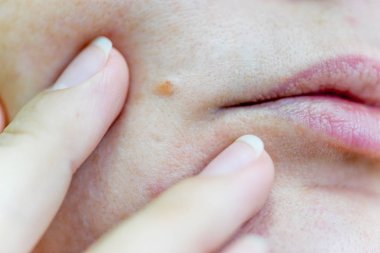 bir Doğum lekesi veya bir kadın cilt üzerinde bir köstebek